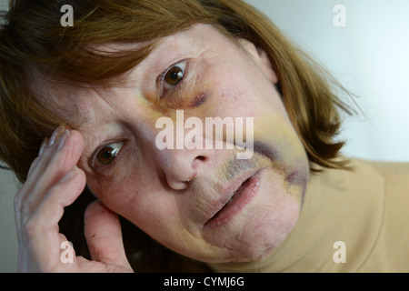 Battered and bruised woman portraying domestic violence. ear relationship violence injuries injured treatment frightened scared wife Stock Photo