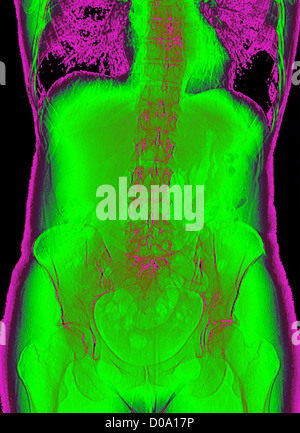 PELVIS, X-RAY Stock Photo