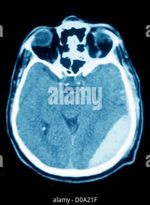 EPIDURAL HEMATOMA, SCAN Stock Photo