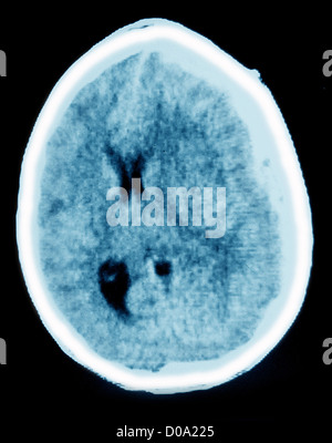 HEMATOMA, BRAIN SCAN Stock Photo