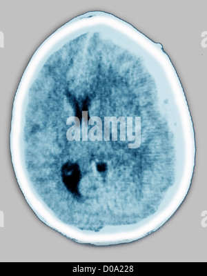 HEMATOMA, BRAIN SCAN Stock Photo