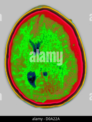 HEMATOMA, BRAIN SCAN Stock Photo