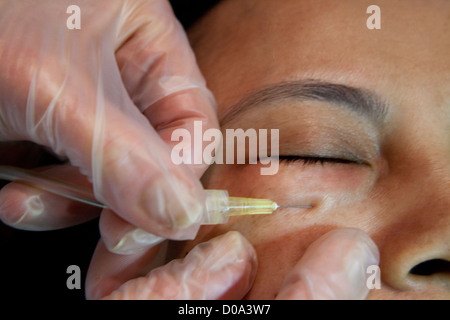 CARBOXYTHERAPY Stock Photo