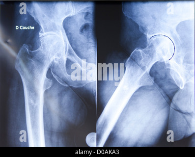 HIP PROSTHESIS, SURGERY Stock Photo