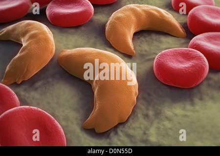 Sickle-cell disease sickle-cell anaemia or drepanocytosis is recessive genetic blood disorder characterized red blood cells Stock Photo