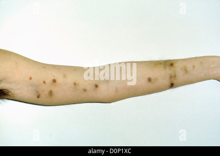 Kaposi's sarcoma on arm AIDS patient. Kaposi's sarcoma are common opportunistic side-infections people HIV-AIDs It is cancer Stock Photo