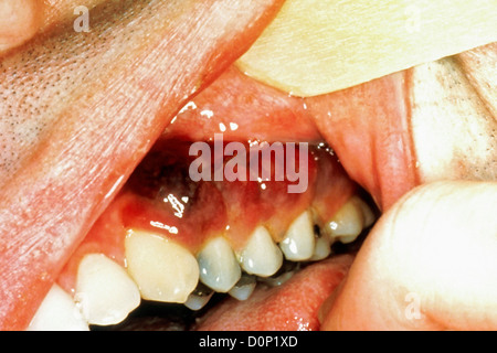 Kaposi's sarcoma in mouth AIDS patient. Kaposi's sarcoma are common opportunistic side-infections people HIV-AIDs It is cancer Stock Photo