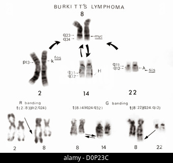 A partial karyotype showing translocations involving Chromosome 8 Chromosomes 2 14 22 in Burkitt's lymphoma type cancer. Stock Photo