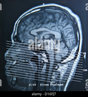 A magnetic resonance imaging scan of the human brain. Stock Photo