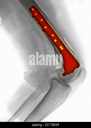 X-ray of knee repair of fractured distal femur Stock Photo