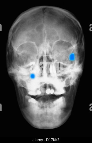 X-ray of head showing two bullets in the skull