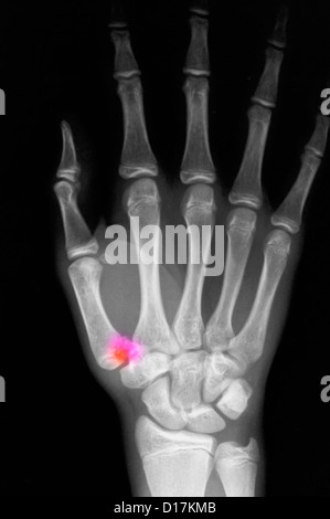 X-ray of fracture through base of thumb metacarpal Stock Photo