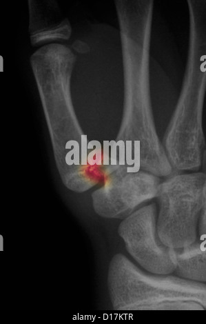 X-ray of fracture through base of thumb metacarpal Stock Photo