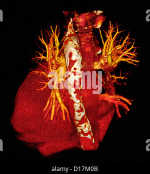 CT scan of heart with calcific aorta Stock Photo
