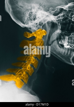 interpreting cervical spine x rays