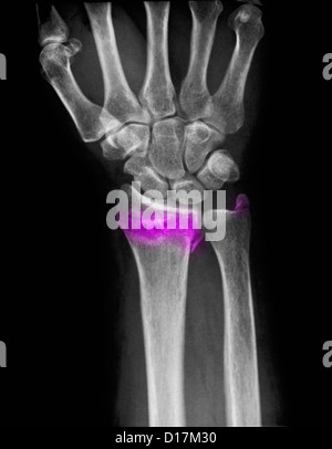 wrist X-ray of comminuted fracture of radius Stock Photo