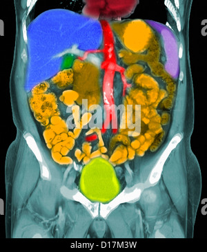 CT scan of metastases of prostate cancer Stock Photo