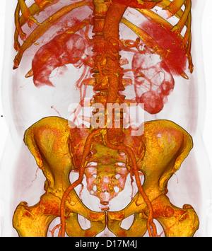 3D CT scan of atherosclerotic plaque, lower aorta Stock Photo