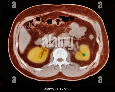 CT scan of abdomen with small kidney stone Stock Photo