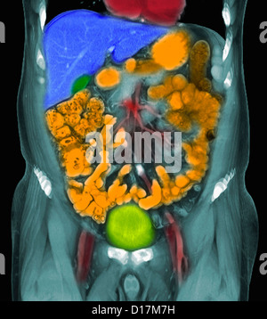 CT scan of metastases of prostate cancer Stock Photo