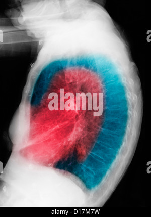 CXR of elderly woman smoker with COPD Stock Photo