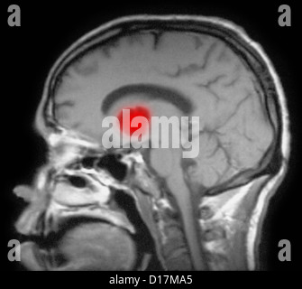 Cryptococcal meningitis in patient with AIDS Stock Photo