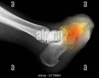Foot X-ray showing amputation for diabetes Stock Photo
