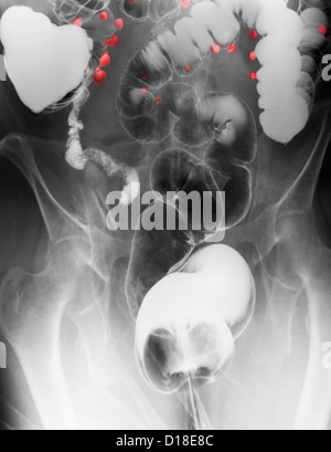 barium contrast X-ray, diverticulosis in the colon Stock Photo