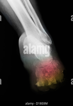 Foot X-ray showing amputation for diabetes Stock Photo