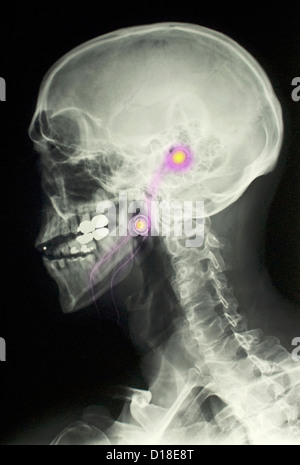 X-ray of the head of a man wearing iPod earphones Stock Photo