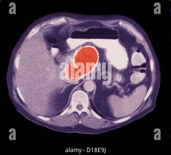 Pancreatic pseudocyst seen on MRI Stock Photo