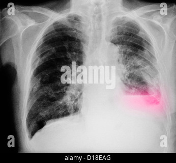 Chest X-ray of an 84 year old man with lung cancer Stock Photo