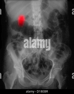 X-ray showing a so-called porcelain gallbladder Stock Photo