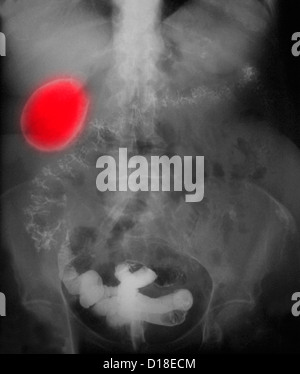 X-ray showing a so-called porcelain gallbladder Stock Photo