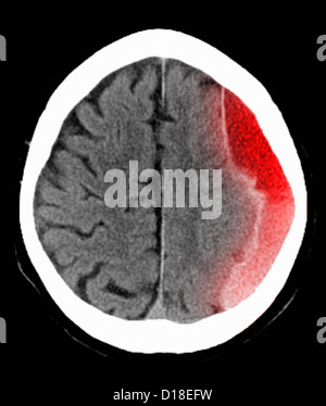 CT scan of the head with subdural hematoma Stock Photo