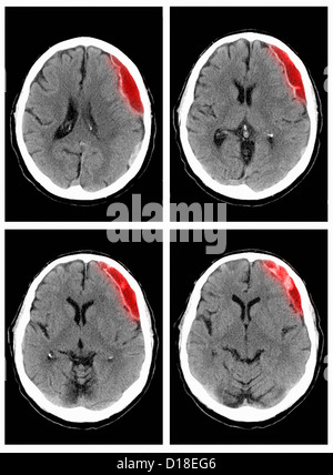 CT scan of the head with subdural hematoma Stock Photo