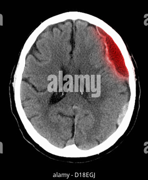 CT scan of the head with subdural hematoma Stock Photo