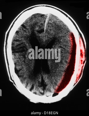 Head CT scan with subdural hematoma, atrophy Stock Photo