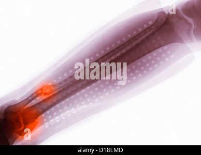 X-ray of a fractured ankle Stock Photo