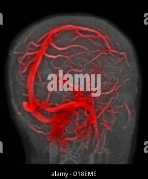 Normal brain MRI, magnetic resonance venography Stock Photo