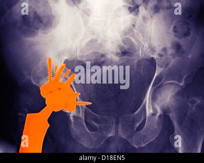 X-ray of a hip replacement in a 56 year old man Stock Photo