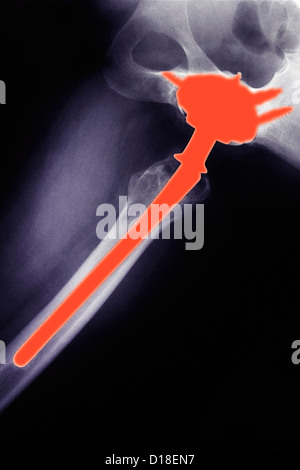 X-ray of a hip replacement in a 50 year old woman Stock Photo