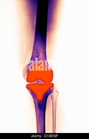 knee replacement in a 61 year old female Stock Photo