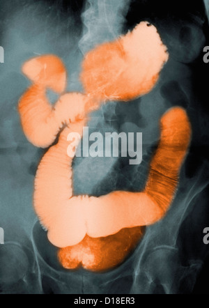 Barium contrast X-ray of the abdomen Stock Photo