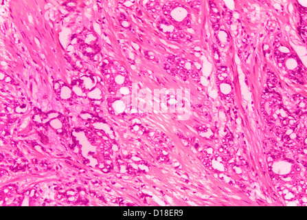 Histopathology of adenocarcinoma of the prostate Stock Photo