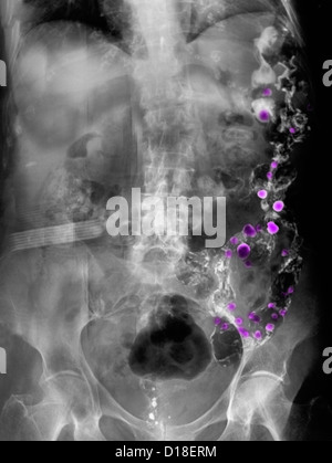 X-ray showing diverticulosis Stock Photo