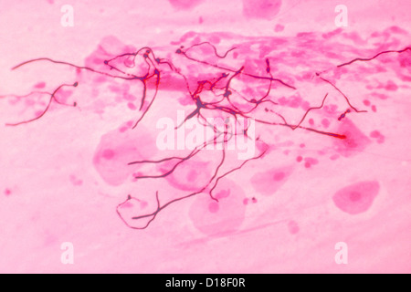 Light micrograph, Candida albicans in lung tissue Stock Photo