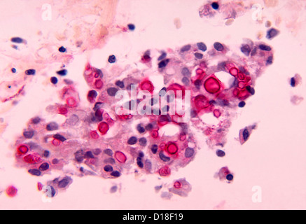 light micrograph showing cryptococcosis in lung Stock Photo
