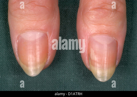 Median nail dystrophy - Stock Image - M140/0437 - Science Photo Library
