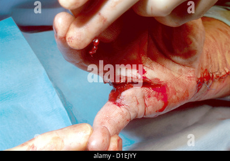 Lacerations of hand and arm. The arm has been sutured. Stock Photo